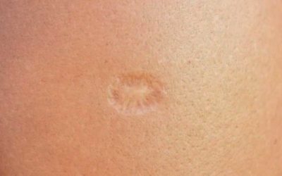 ¿Por qué no tengo esa marca característica en el brazo si me vacunaron contra la tuberculosis?